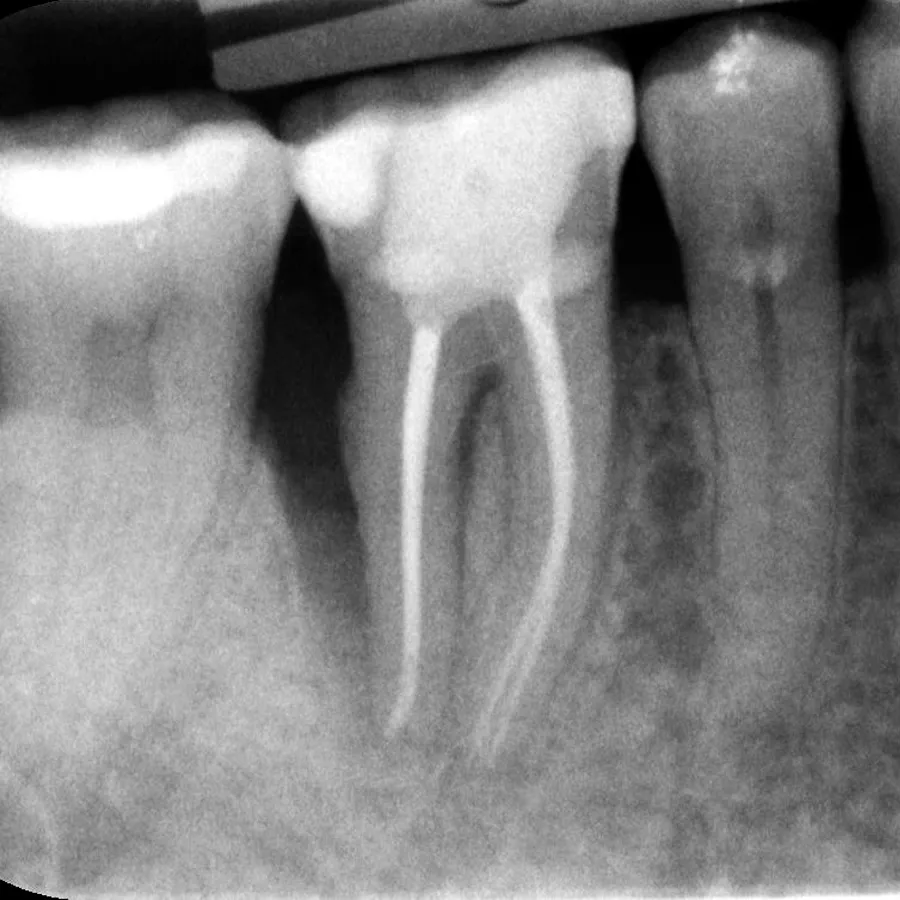 Tratamiento de conductos y endodoncia en MAS Healthcare