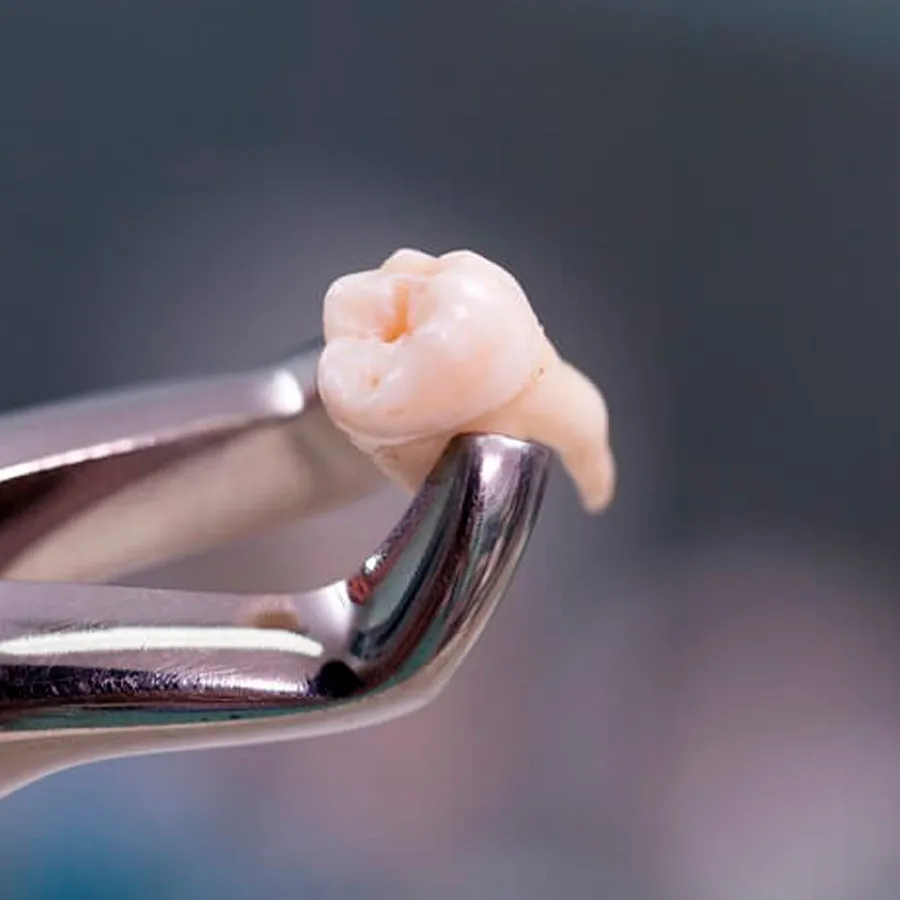 Extracciones dentales en MAS Healthcare