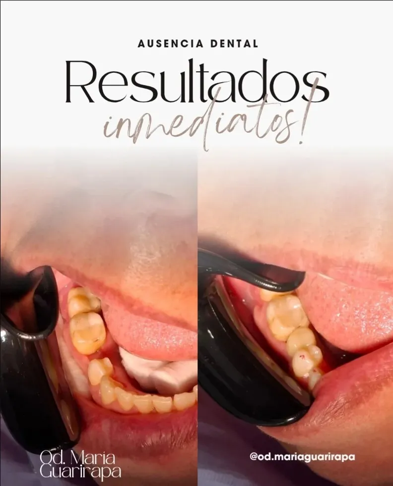 Restitución dental con filamento de fibra de vidrio y resina compuesta. ¿Tienes ausencias dentales que quieres resolver?
#odontologiaestetica #odontologoscaracas