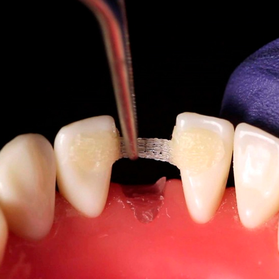 Puente con fibra de polietileno para rehabilitación dental